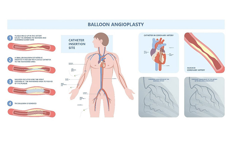 カテーテル治療のイメージ
