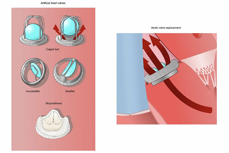 弁置換術のイメージ