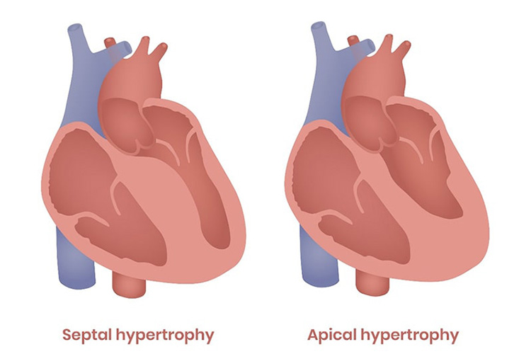 心筋症のイメージ