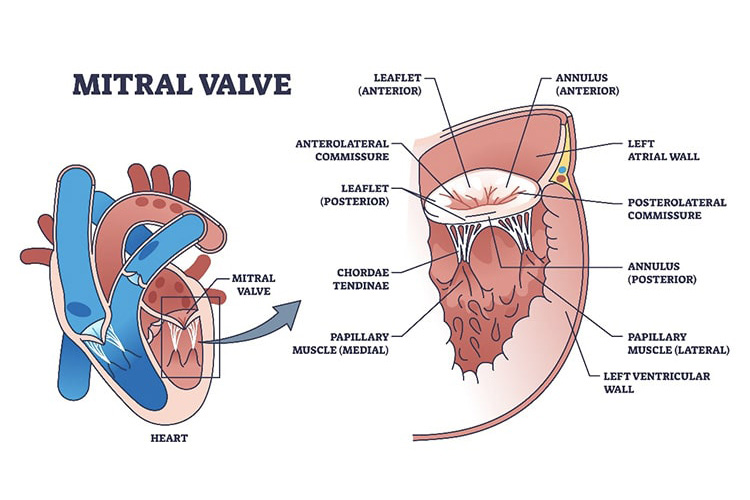 僧帽弁膜症のイメージ