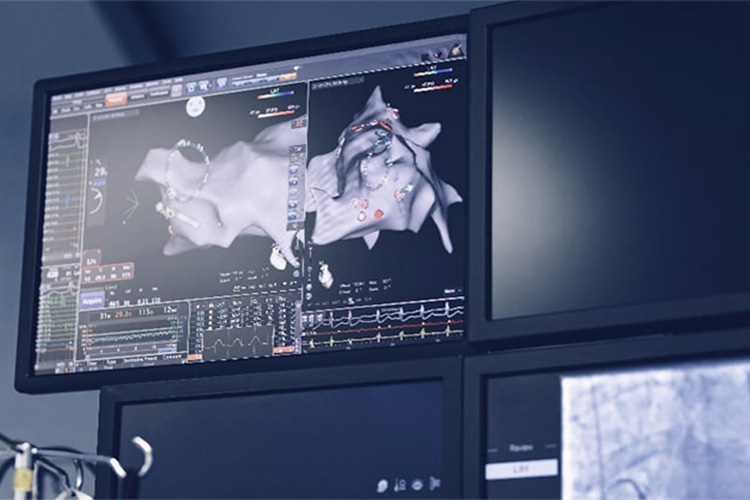 カテーテルアブレーションのイメージ