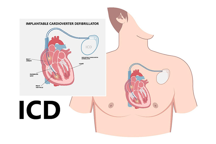 心臓再同期療法のイメージ