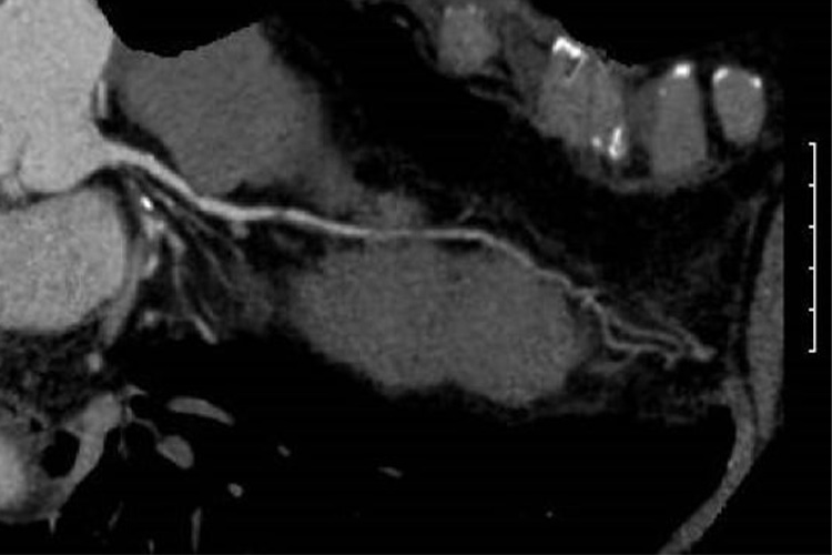 冠動脈CT検査のイメージ