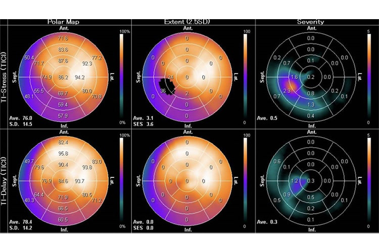 心臓核医学検査のイメージ