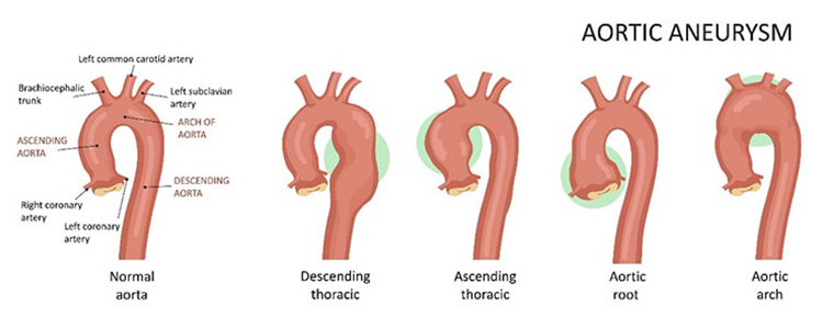 大動脈瘤のイメージ