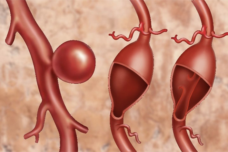 大動脈瘤のイメージ