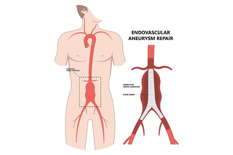 ステントグラフトのイメージ