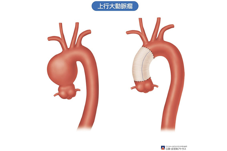 人工血管のイメージ