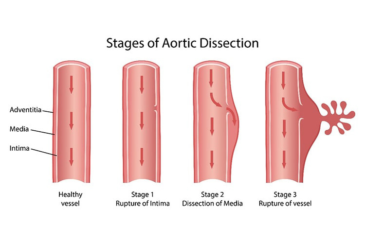 大動脈解離のイメージ