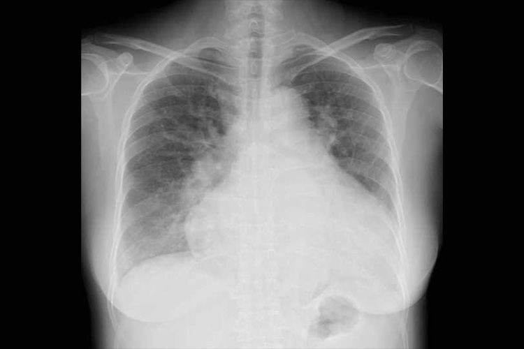 胸部レントゲン検査のイメージ