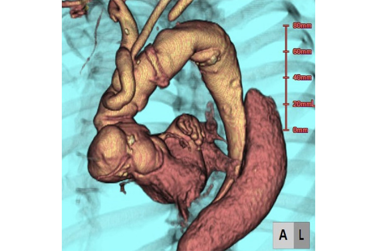 造影CT検査のイメージ
