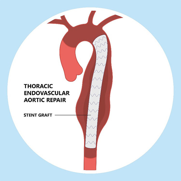 ステントグラフト内挿術のイメージ