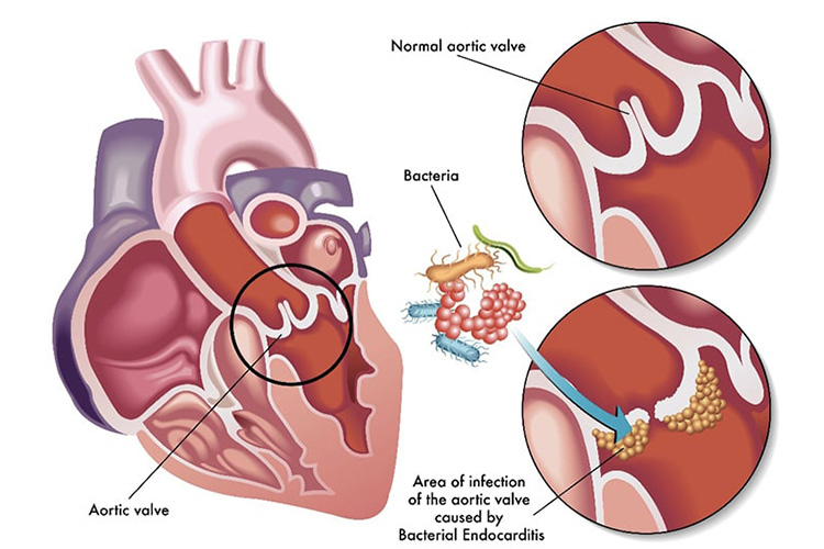 感染性心内膜炎のイメージ