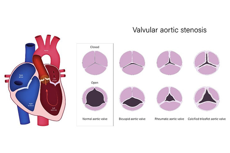 大動脈弁狭窄症の血管の断面図