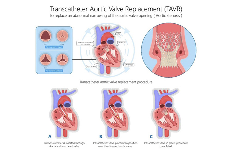 カテーテル治療のイメージ