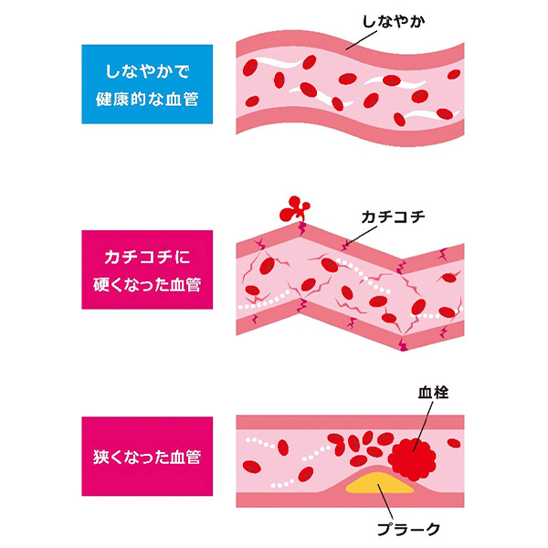 動脈硬化のイメージ