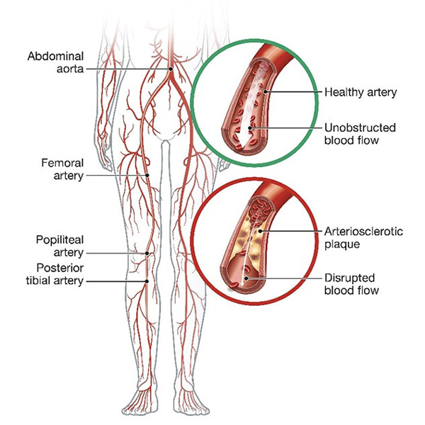 心筋梗塞のイメージ
