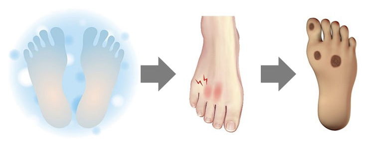 心筋梗塞のイメージ