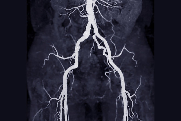 心筋梗塞のイメージ