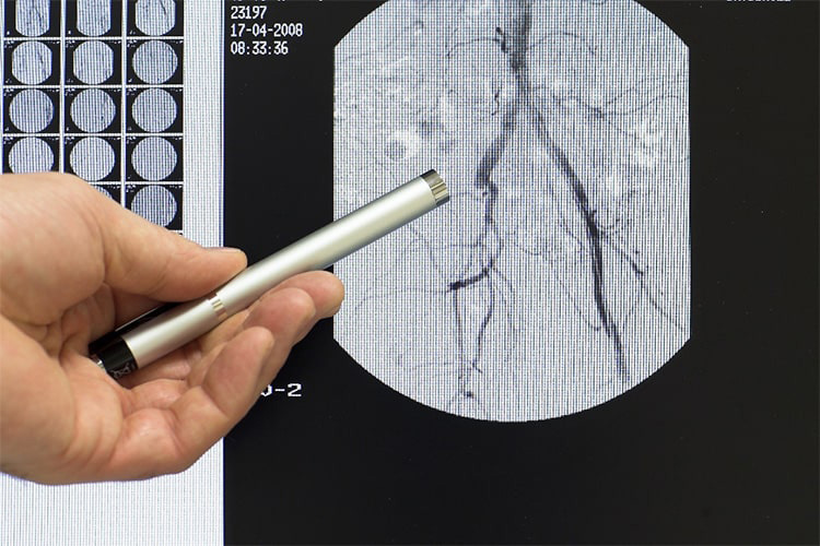 血管造影検査のイメージ