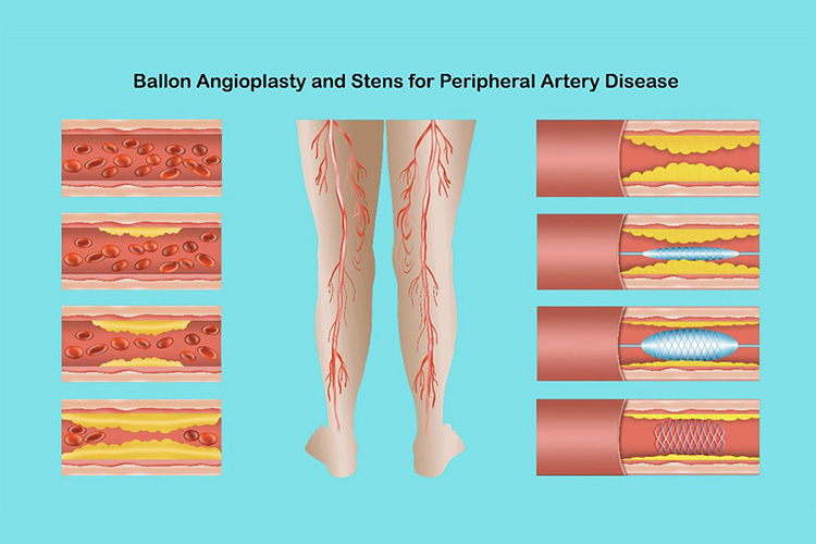 血管内治療のイメージ