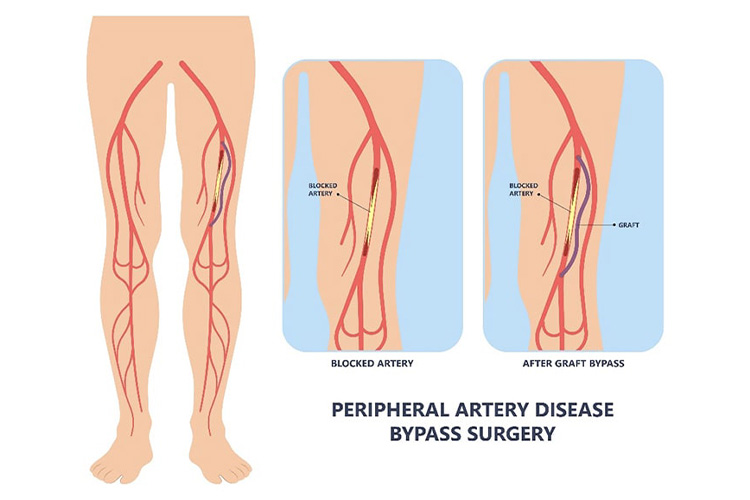血管内治療のイメージ