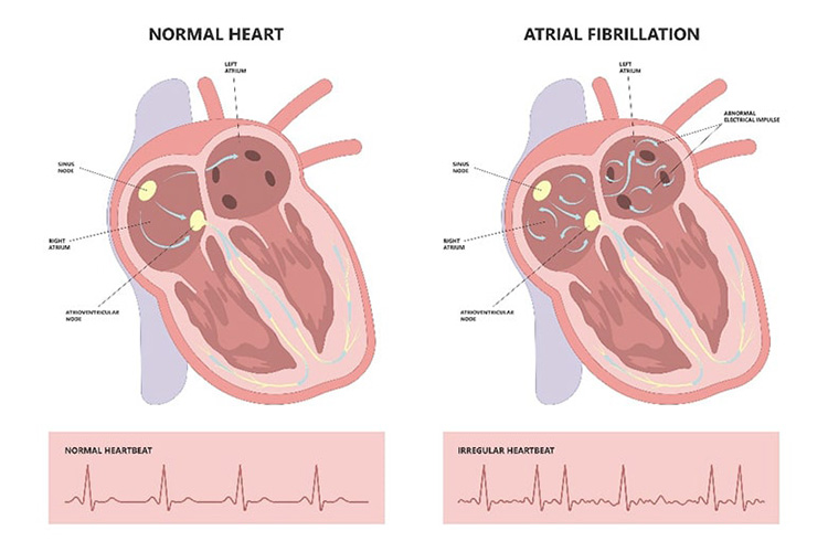 大動脈弁狭窄症の血管の断面図