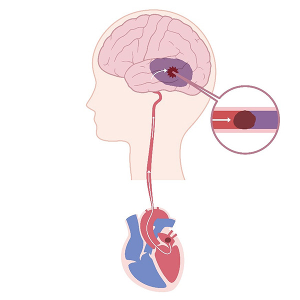 脳梗塞のイメージ