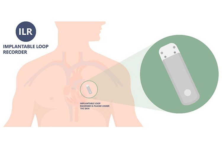 ループレコーダーのイメージ