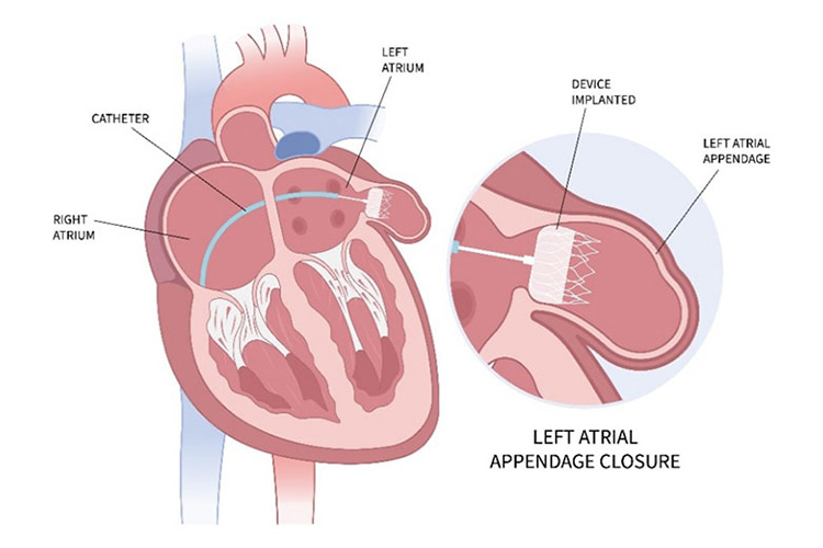 左心耳を閉鎖するイメージ
