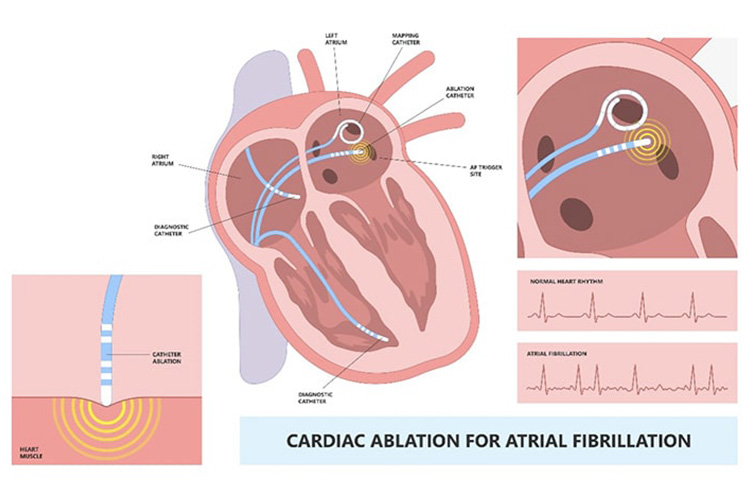 カテーテルアブレーションのイメージ
