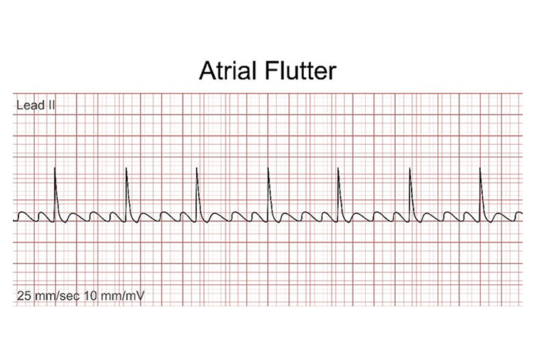 大動脈弁狭窄症の血管の断面図