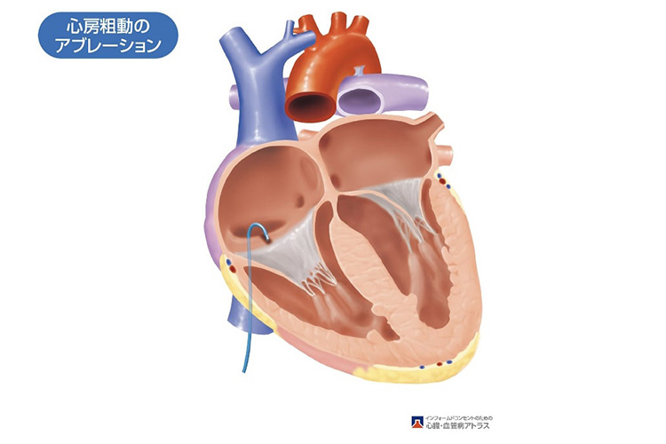 カテーテルアブレーションのイメージ