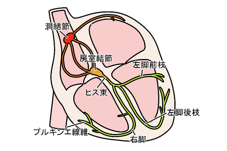 房室ブロックのイメージ