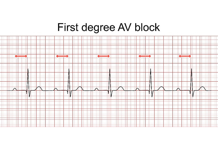 1度房室ブロックの波形イメージ