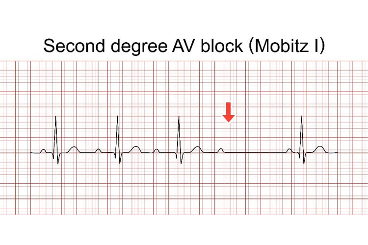 2度房室ブロックの波形イメージ
