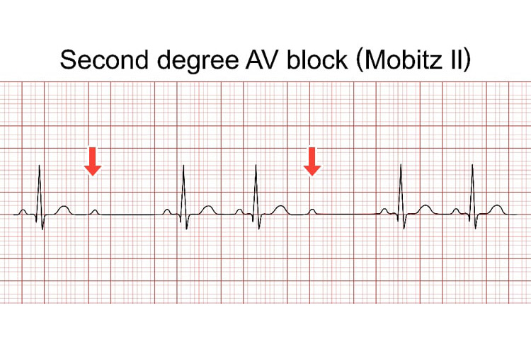 2度房室ブロックの波形イメージ