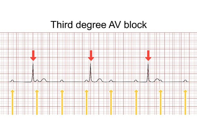 3度房室ブロックの波形イメージ