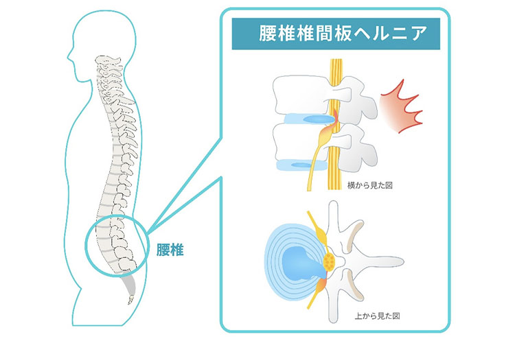 椎間板ヘルニアのイメージ