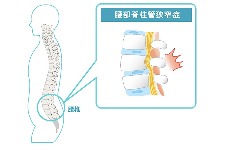 脊柱管狭窄症のイメージ