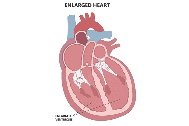 拡張型心筋症のイメージ