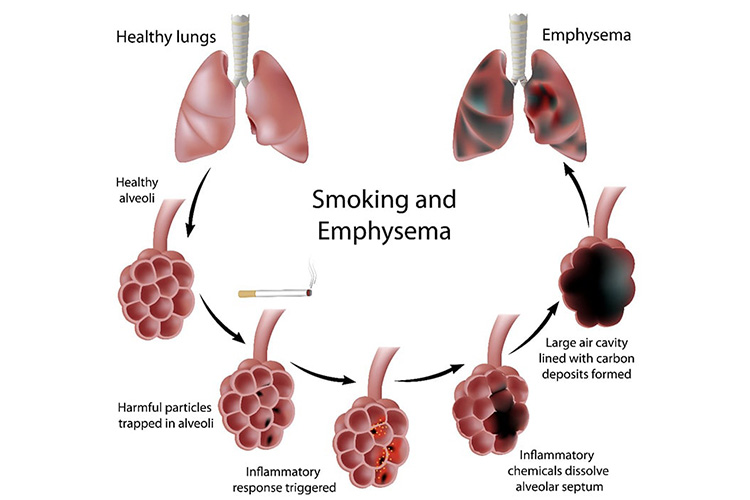 慢性閉塞性肺疾患のイメージ
