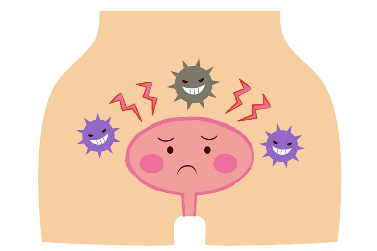 膀胱炎のイメージ