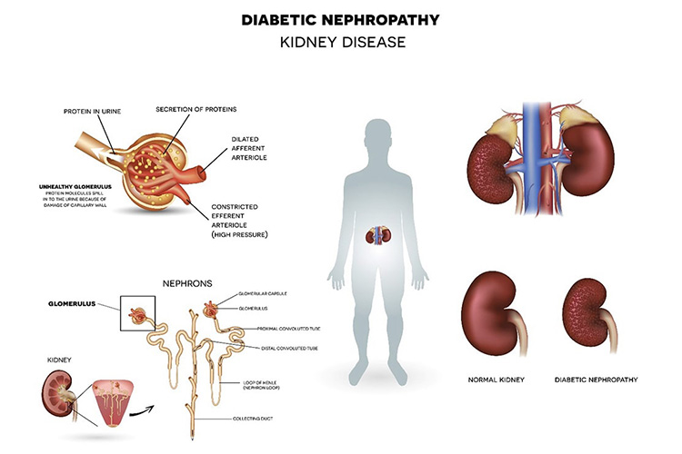 糖尿病性腎症のイメージ