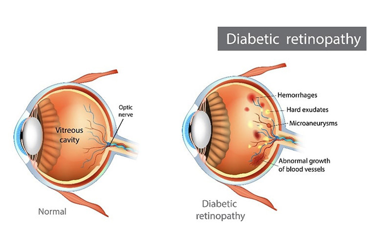 糖尿網膜症のイメージ