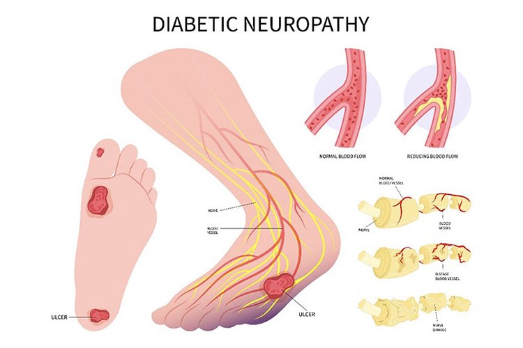 糖尿網膜症のイメージ