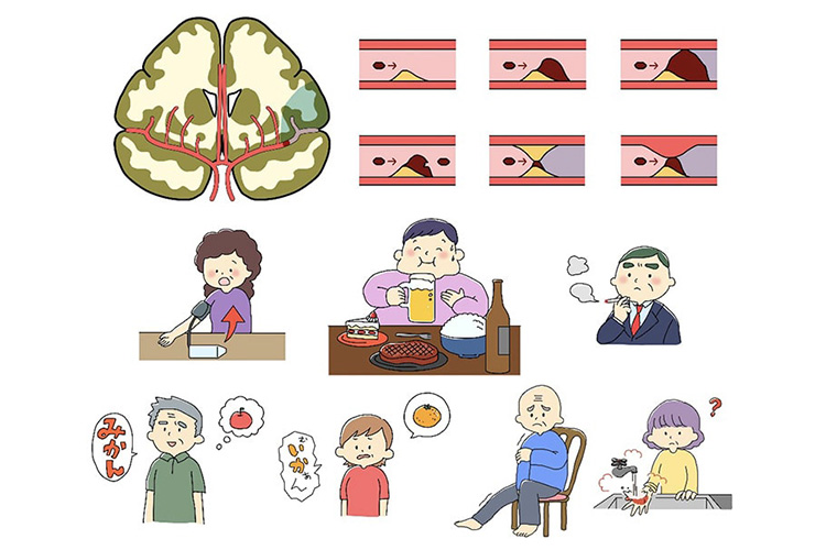 脳梗塞のイメージ