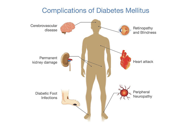 心筋梗塞のイメージ