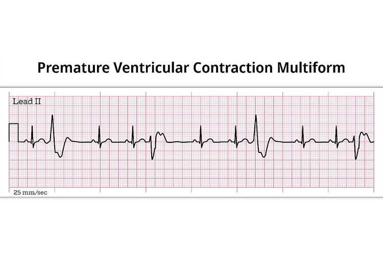 期外収縮のイメージ