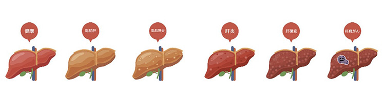 脂肪肝のイメージ